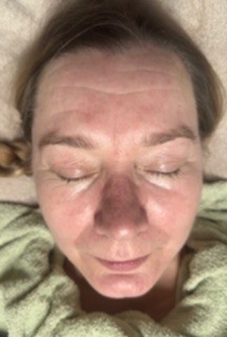 retix-c smart dna terapia atooppinen iho 2 viikon jälkeen