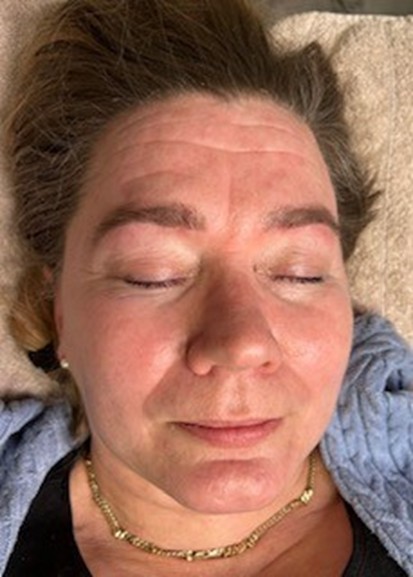 retix-c smart dna terapia atooppinen iho 3 päivää jälkeen