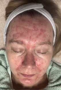 retix-c smart dna terapia atooppinen iho ennen hoitoa