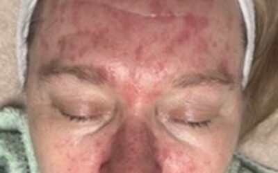 Atoppinen iho rauhoittui Retix.C Smart DNA Terapia -hoidolla – Minnan asiakastarina